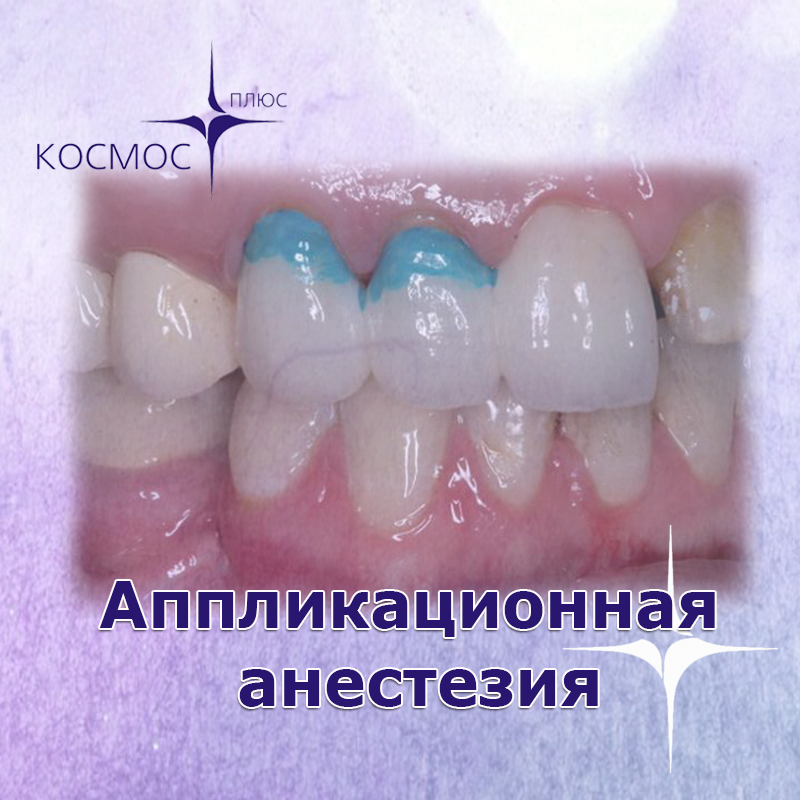 Аппликационная (поверхностная) анестезия
